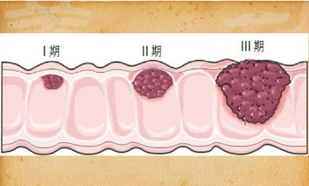 肠癌