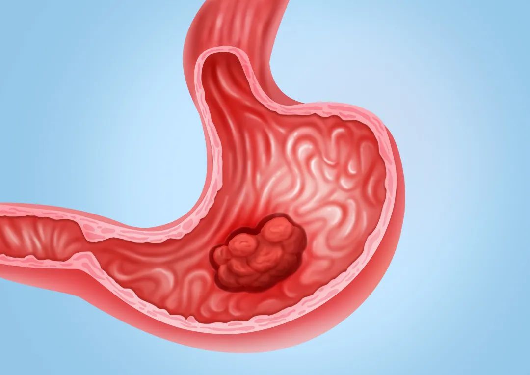 胃癌胃出血已改善后可否服华蟾素胶囊?(图1)