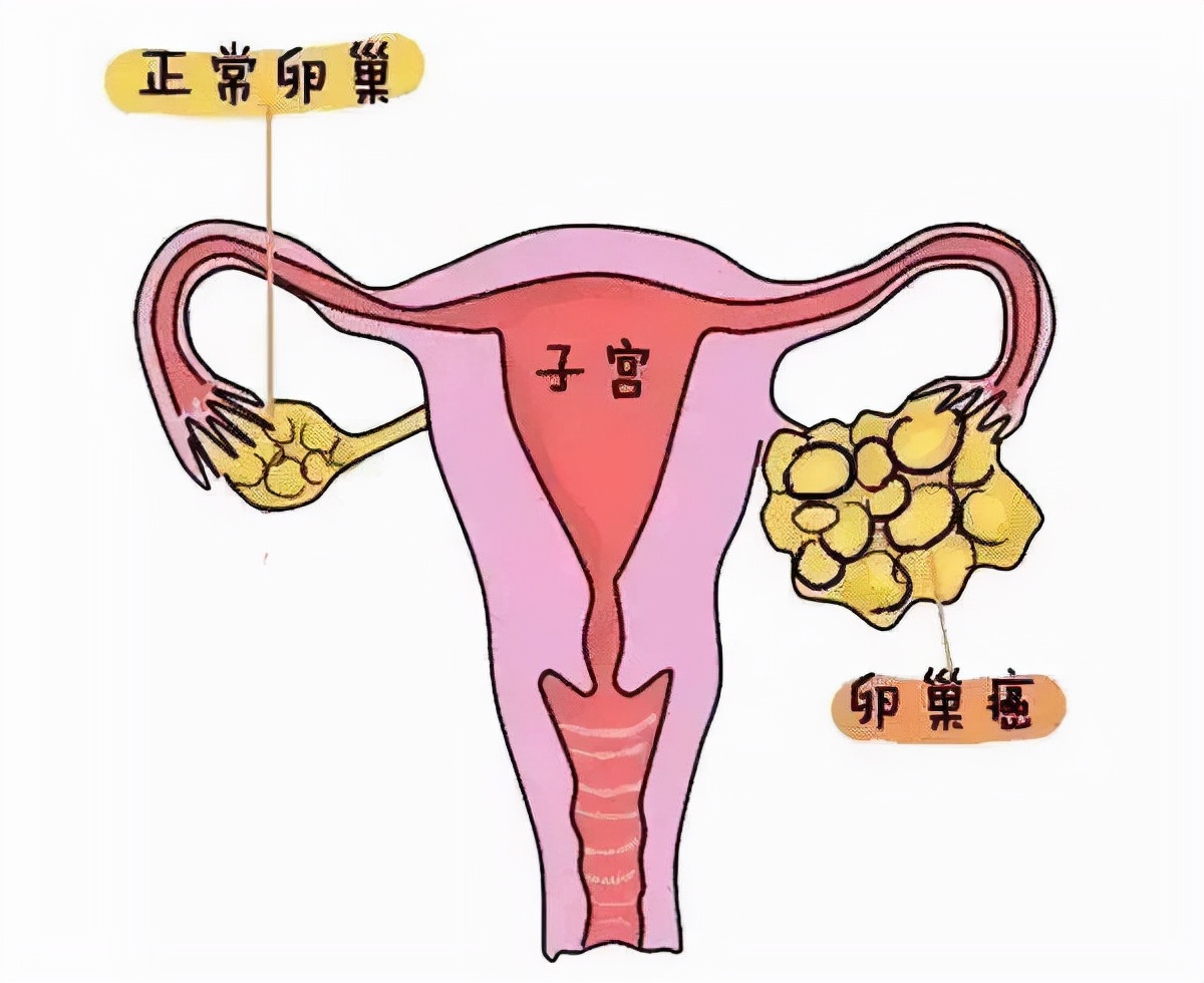 戈舍瑞林对卵巢癌有用吗?(图1)
