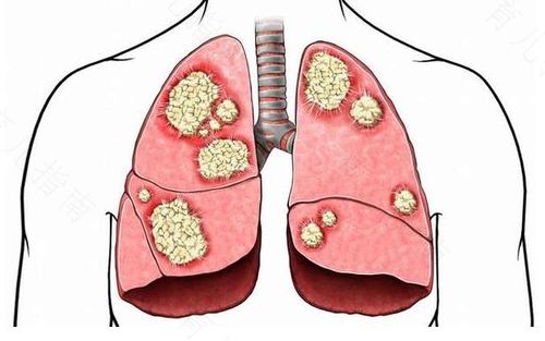 肺癌基因检测没有突变有药可用吗?(图1)