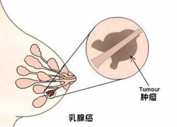 三阴乳腺癌可以服用中成药治疗吗?(图1)