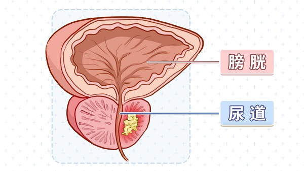 前列腺癌用阿比特龙无效怎么办?(图1)