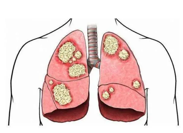 肺癌清晰图.png