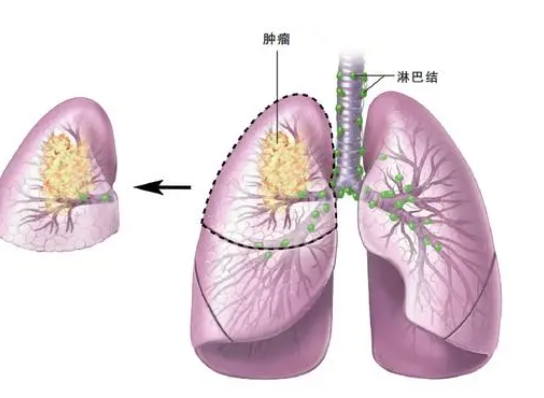 肺癌.png