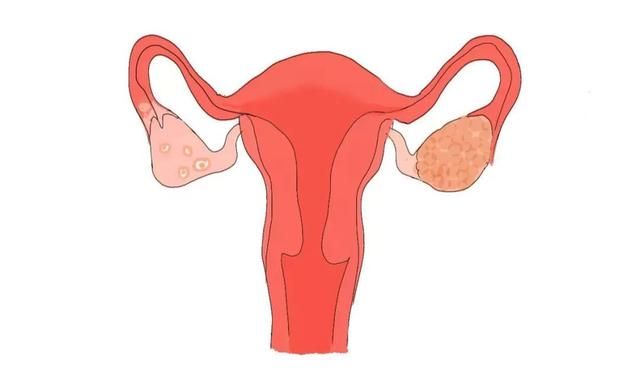 复方万年青对卵巢癌有没有用?(图1)