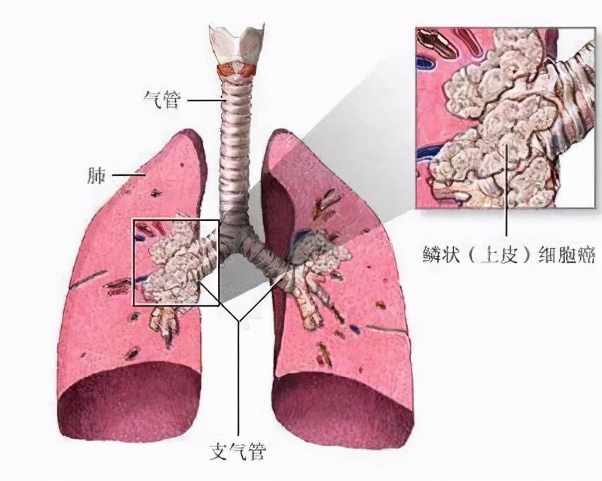 肺鳞癌有靶向药可以用吗,无基因突变(图1)