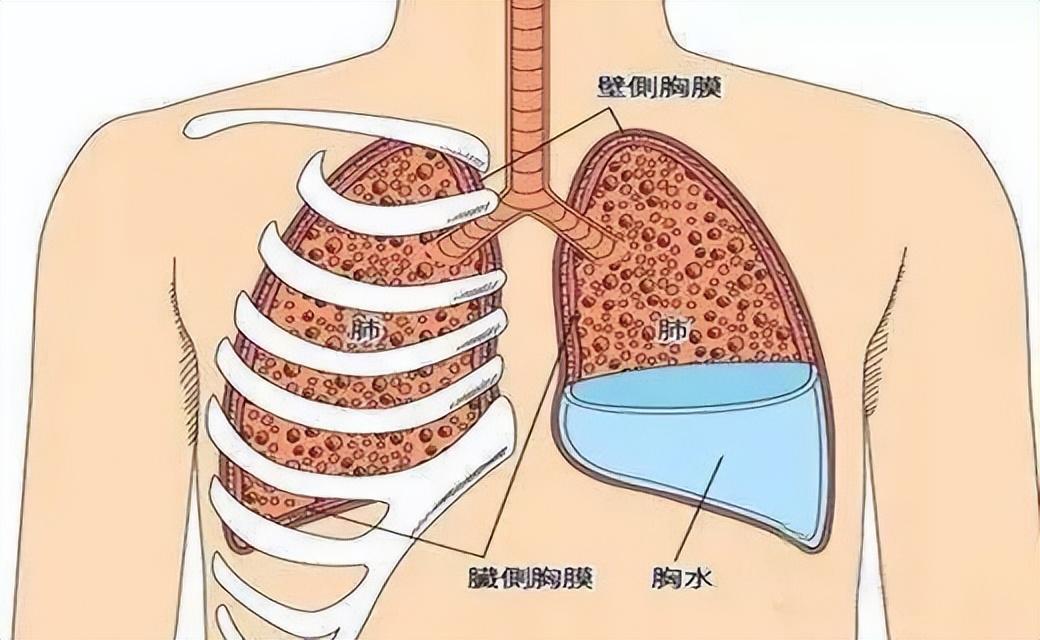胸腔积液有脓性积液还可以继续吃安罗吗?(图1)