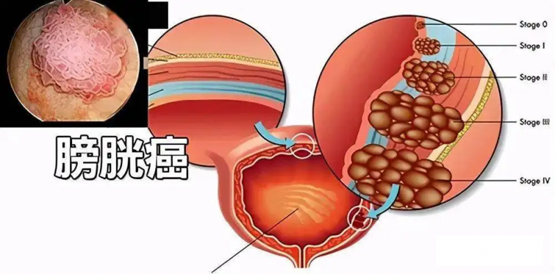 膀胱癌术后尿道感染用什么药?(图1)