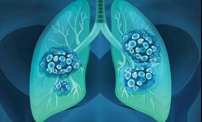 肺癌用华蟾素胶囊还需用靶向药吗?(图1)
