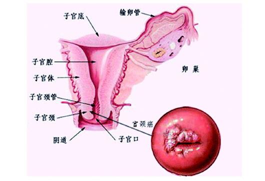 宫颈鳞癌可以用安罗替尼吗?(图1)