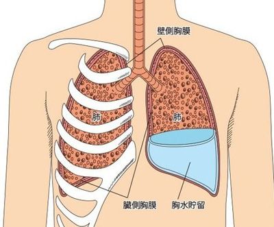 臌症丸对肺癌胸水有效吗?(图1)