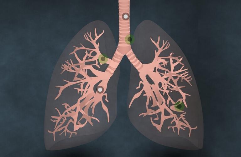 肺癌刚确诊吃一代还是三代靶向药好?(图1)