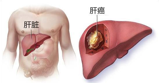 肝转肺用贝伐加阿替利珠单抗,全身骨头疼痛,掉头发,应该怎么办?(图1)