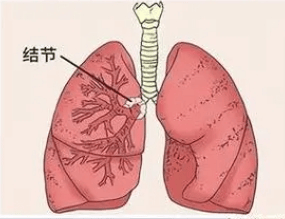 肺结节用什么有效果?(图1)