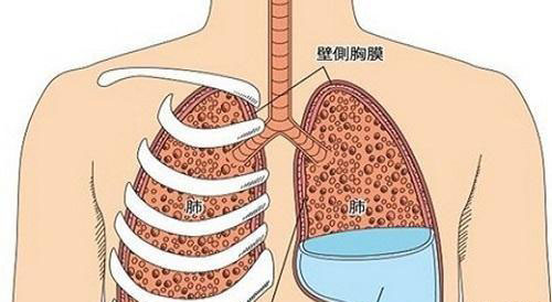 肺癌胸腔积液以及肝癌腹水应如何解决(图1)