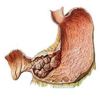胃间质瘤用药方案(图1)