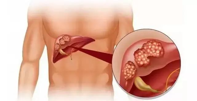 肝癌晚期用贝伐加信迪利出现便血是什么原因?(图1)