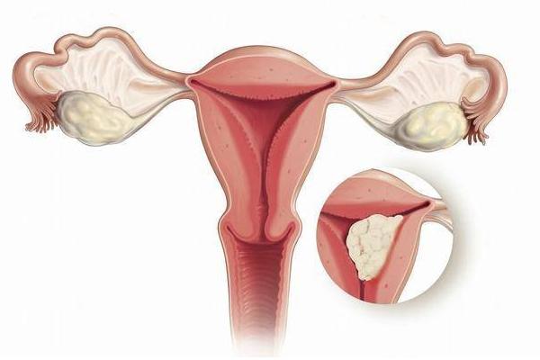 卵巢癌铂耐药复发怎么办(图1)