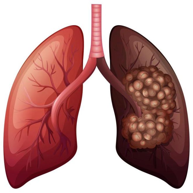 肺癌广泛转移且免疫耐药怎么办?(图1)