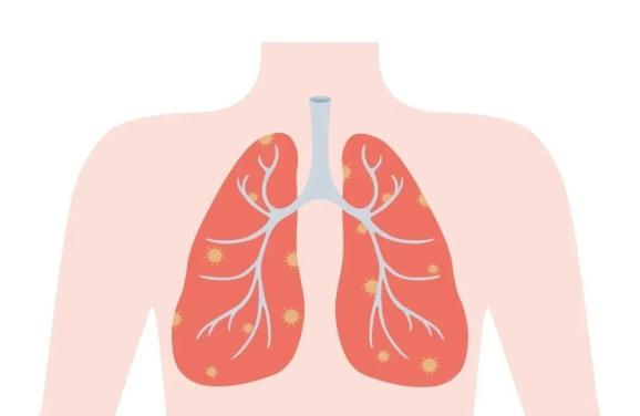 肺癌吃阿美和易瑞沙都耐药了怎么办?(图1)