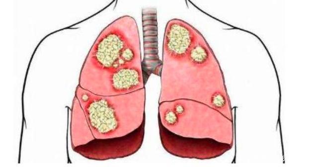 肺癌复发用安罗联合白蛋白紫杉醇有效吗?(图1)