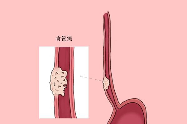 食道癌淋巴结转移不做手术可以吗?(图1)