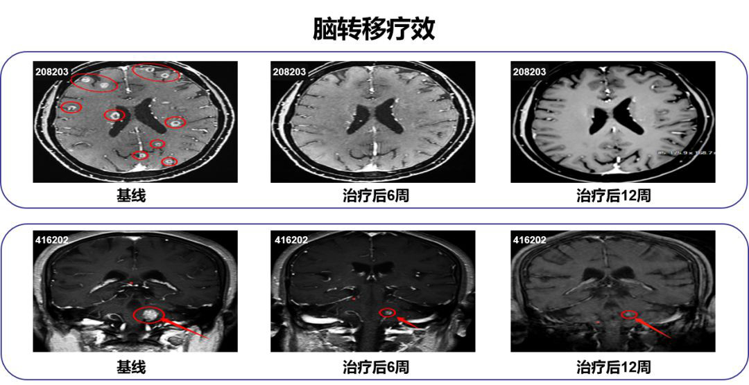 肺癌脑转移