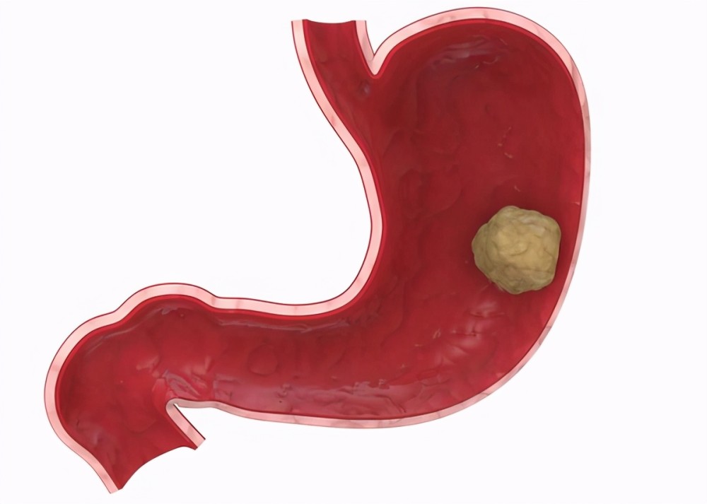 胃腺癌早期可以吃华蟾素胶囊治疗吗?(图1)