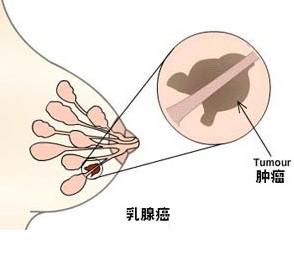 乳腺癌患者吃槐耳颗粒要吃几个月(图1)