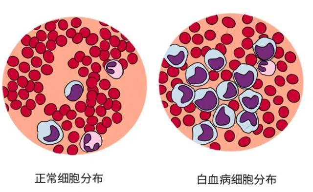 达沙替尼片能治白血病吗(图1)
