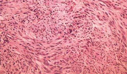 平滑肌肉瘤用乐伐联合万年青胶囊可以让肿瘤缩小吗(图1)