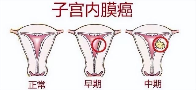 子宫内膜癌用宫瘤宁胶囊效果如何(图1)
