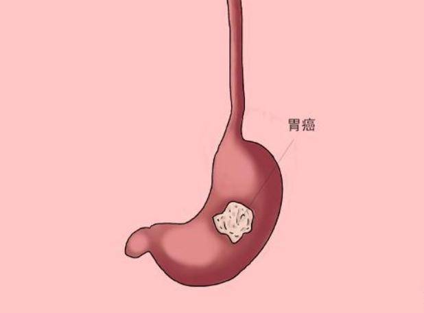 胃癌出现肝转移还能手术治疗吗(图1)