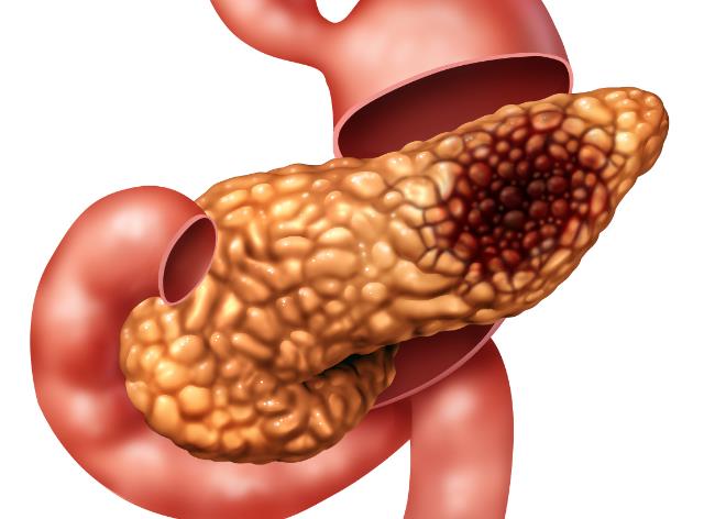 胰腺癌肝转移经常饭后腹痛是怎么回事(图1)