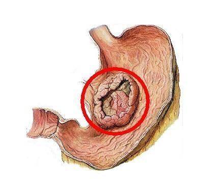 胃腺癌做了腹腔热灌注治疗后身体非常虚弱可以用银灵合剂吗(图1)