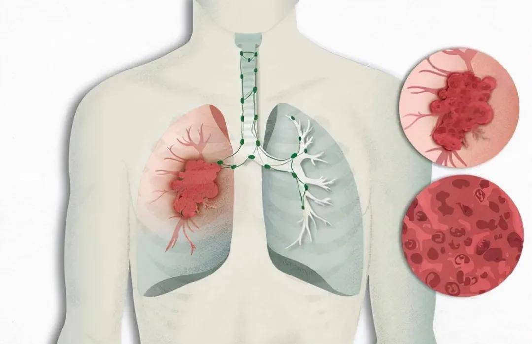 肺腺癌胸闷气喘低烧汗多如何用药(图1)