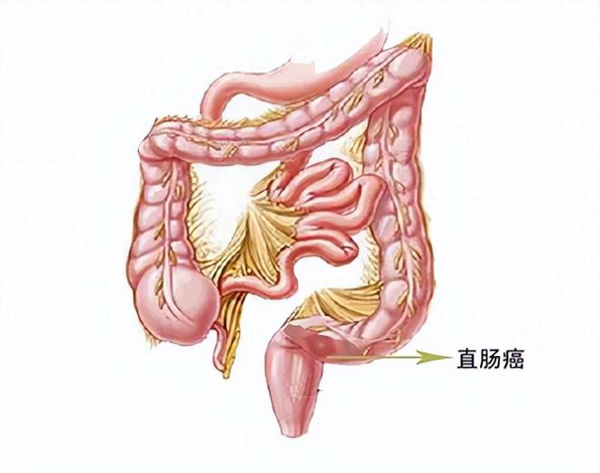 直肠癌术后腹腔引流口一直外渗液体的原因和治疗控制手段(图1)