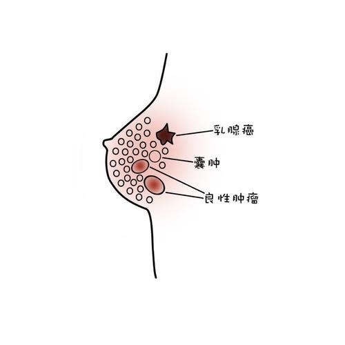 氟维司群加爱博联合治疗乳腺癌效果如何(图1)