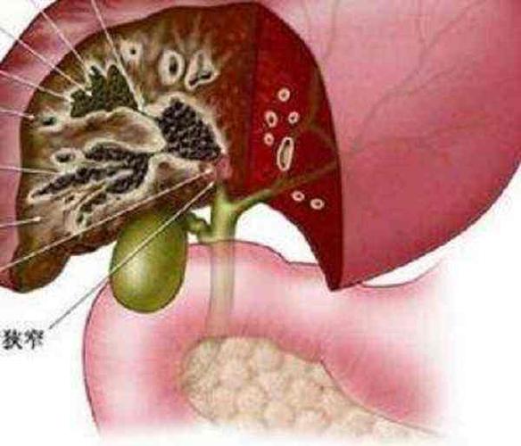 肝胆管瘤晚期腹胀腹痛难忍,排便减少怎么治疗(图1)