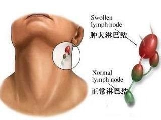 甲状腺癌