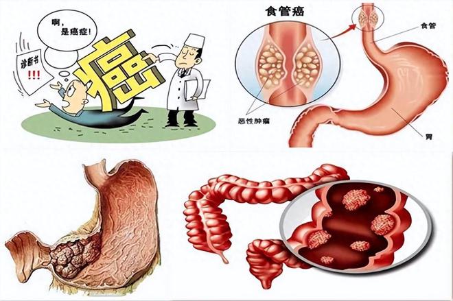 香菇多糖联合化疗对消化道肿瘤营养不良改善明显(图1)