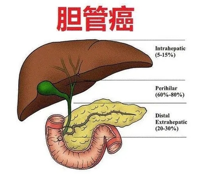 胆管癌